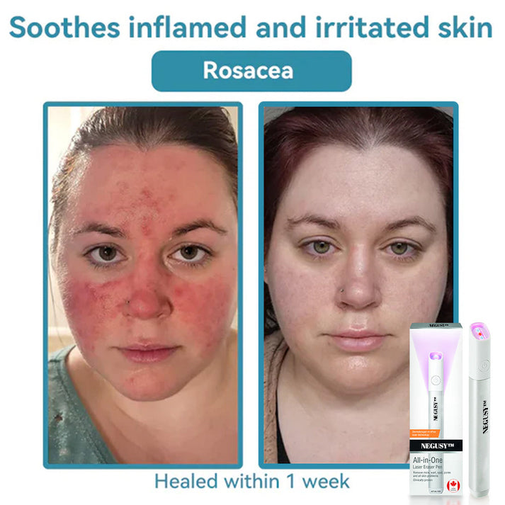 All-in-One CO₂ Laser Eraser Pen | Removes Moles, Warts, Skin Flaws & Pigmentation