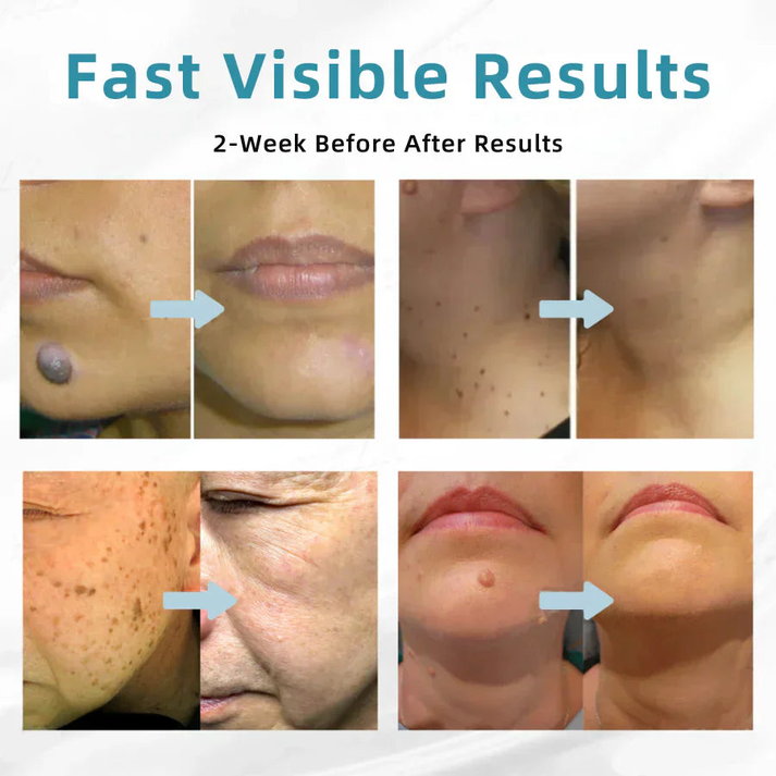 All-in-One CO₂ Laser Eraser Pen | Removes Moles, Warts, Skin Flaws & Pigmentation